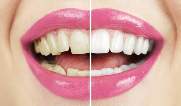 What Makes Ultima White Teeth Whitening Different Macclesfield