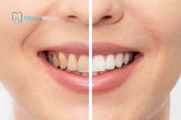 What Is Professional Teeth Whitening