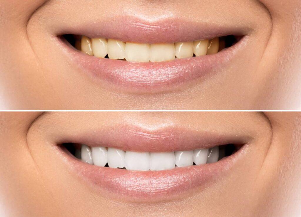 How Can You Protect Your White Smile as a Coffee Lover Macclesfield?