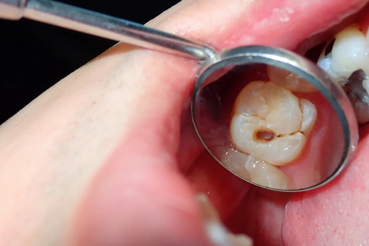 Why Do Teeth Crack? Common Causes to Know Macclesfield
