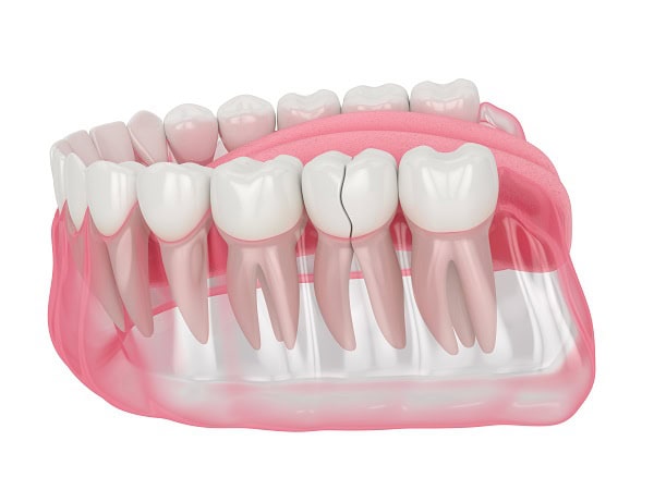 How Can You Manage Pain and Discomfort After a Root Canal Macclesfield?