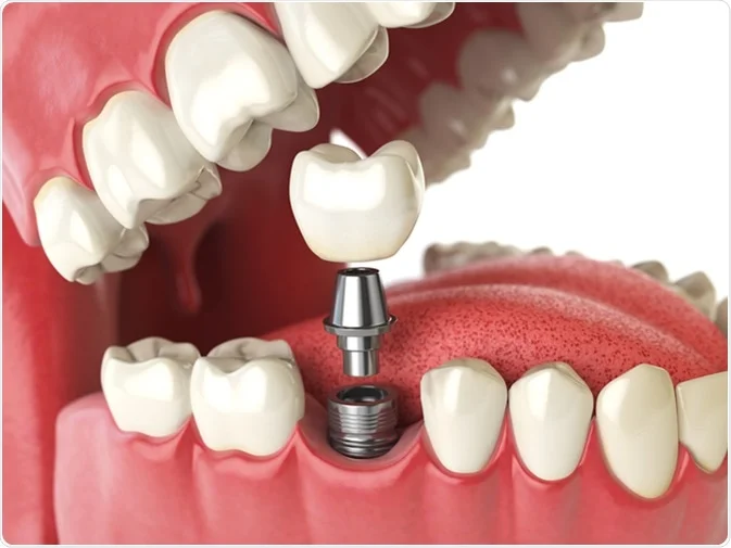 How Do I Decide Which Tooth Replacement Is Right for Me Macclesfield?
