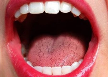 Dry Mouth and Its Role in Tooth Decay Macclesfield