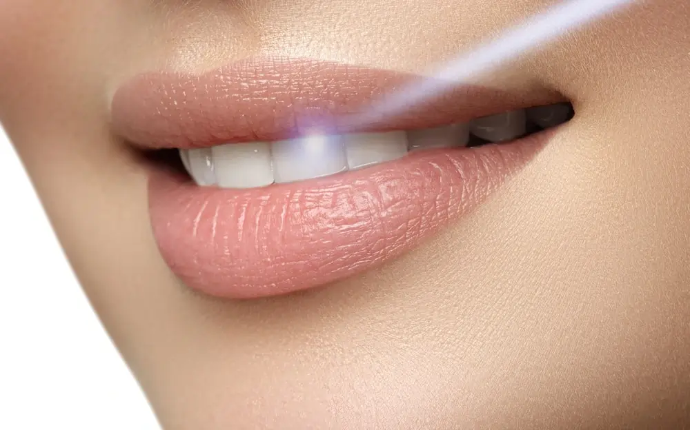 A Smarter Alternative: At-Home Laser Teeth Whitening Macclesfield