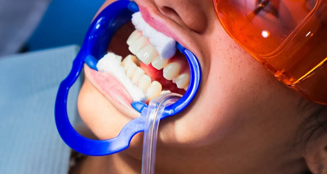 Which Teeth Whitening Method Lasts Longer Macclesfield?