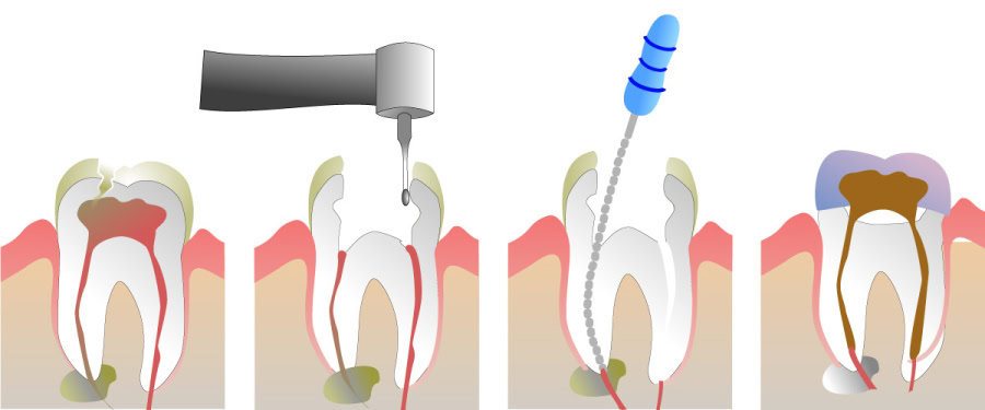 How Do You Properly Care for Your Teeth After a Root Canal Macclesfield