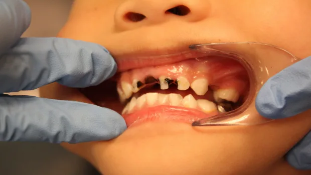 Which Foods and Drinks Cause the Most Damage to Young Smiles Macclesfield?