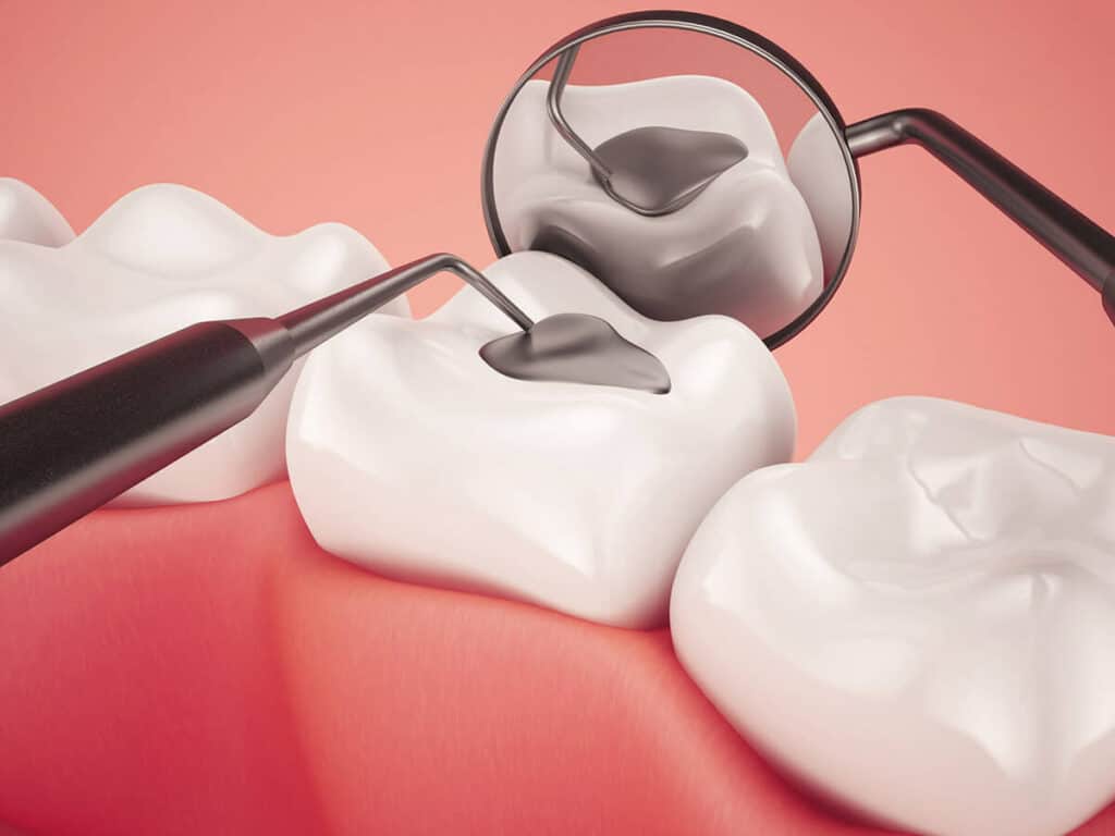 Fighting Cavities and Plaque Buildup Macclesfield