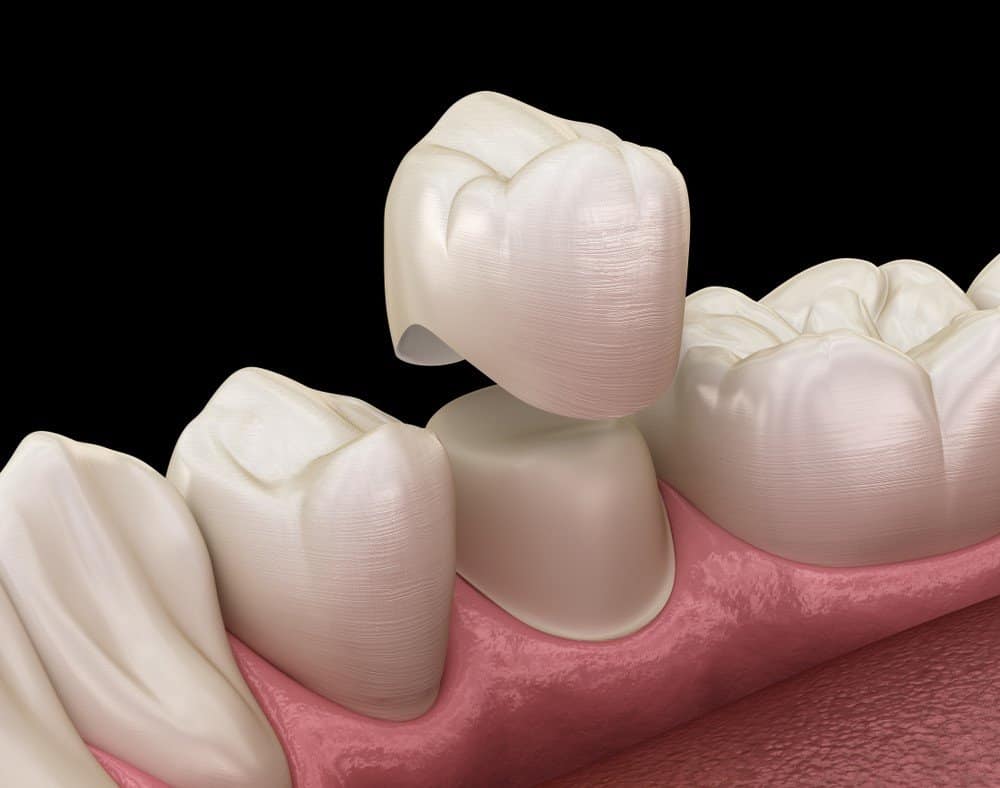 How Can You Prevent Common Dental Crown Problems Macclesfield?