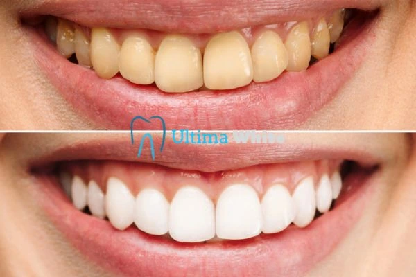 Oral Care Tips for Current and Former Smokers Macclesfield