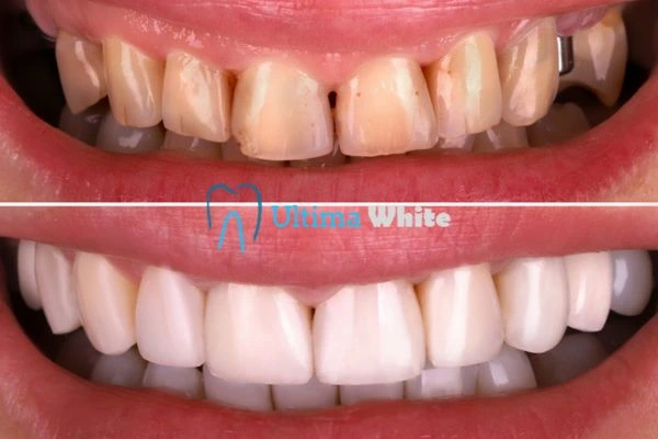 What Makes Instant Teeth Whitening Treatments So Popular Macclesfield?