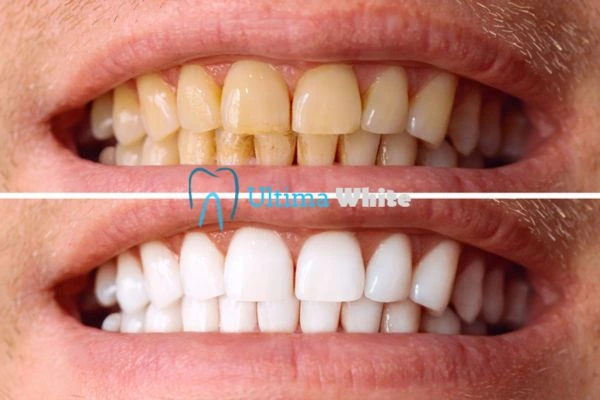 Stained Teeth and Persistent Bad Breath Macclesfield