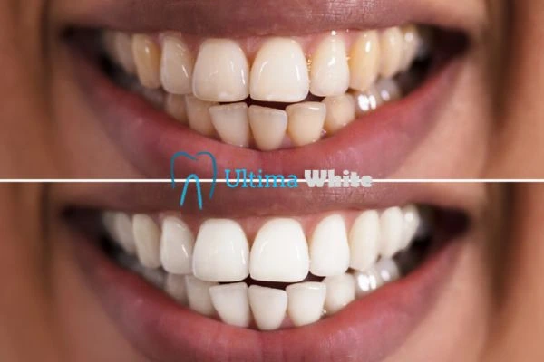 Long lasting results from Ultima White Macclesfield